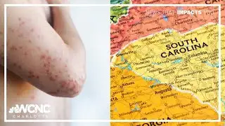 Measles outbreak grows in South Carolina
