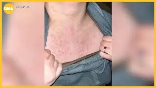 Measles outbreak in South Carolina grows larger