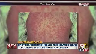 Measles outbreak spreads to 14 states