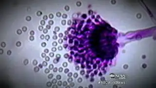 Meningitis Outbreak Linked to Spinal Steroid Injections