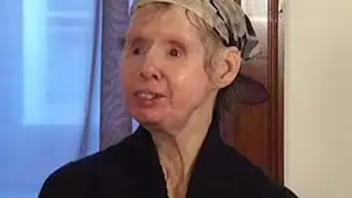 Military Hopes to Learn From Chimp Attack Victim