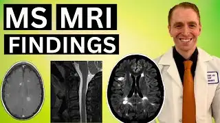 Multiple Sclerosis MRI Findings Explained by Neurologist