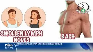 Namibia confirms first case of Mpox - nbc