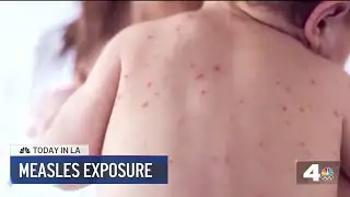 New measles cases reported in Southern California