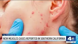 New measles cases reported in Southern California