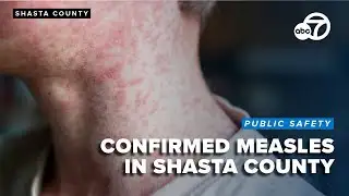 New measles exposure location identified in Shasta County