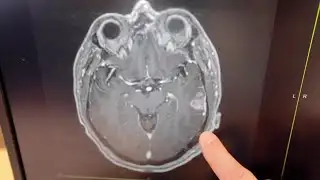 New results show vaccine could help fight brain cancer