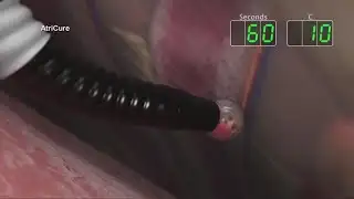 New technique for heart surgery improving recovery time