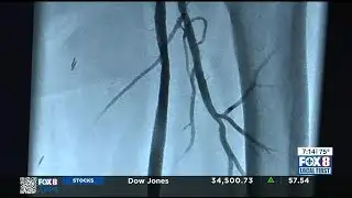 Ochsner Health Beat: PAD Awareness