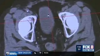 Ochsner Prostate Cancer: New Treatment Options