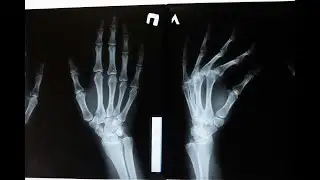 Positive News - Scientists Find a Switch That Could Stop Osteoporosis, Making Bones Stronger