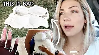 PREGNANCY BELLY CAST *FAIL
