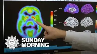Promising clinical trials in Alzheimer