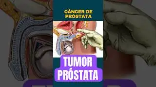 Prostate cancer and its symptoms.