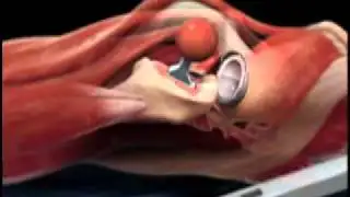 Prosthesis Trial Animation - Direct Anterior Total Hip Replacement