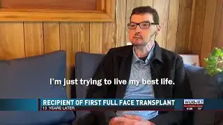 Richard Norris First Full Face Transplant 13 Years Later