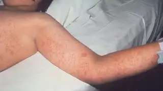 S.C. measles outbreak continues to grow in the Upstate