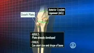 Spike in sports-related knee injuries: study