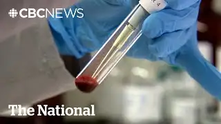 Stage 4 prostate cancer cases increased after reduction in PSA screening, research suggests