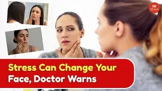 Stress Can Change Your Face: Doctor Explains Cortisol Face