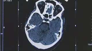 Study explores potential benefits of deep brain stimulation in stroke recovery