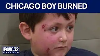 Suburban Chicago boy burned after NeeDoh toy explodes in microwave