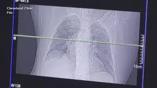 TB cases identified in Manchester, Nashua