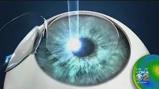The link between Lasik surgery and Suicide.  KDKA