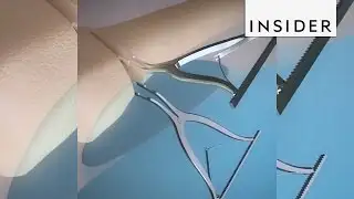 This is the surgery used to fix knock-knee