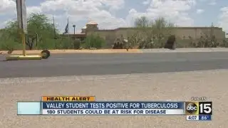Valley student tests positive for tuberculosis