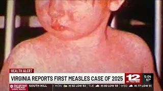Virginia Reports First Measles Case of 2025
