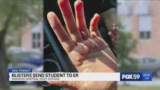 Warren Central student suffers second-degree burns from dance team drill