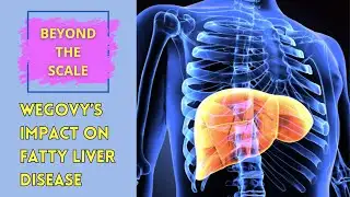 Wegovy and Fatty Liver Disease (MASH): A Game-Changer? | Plus My Week 21 & 22 Progress Update!