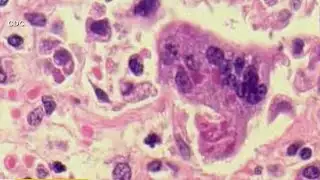 West Virginia confirms first measles case since 2009