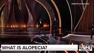 What is Alopecia? Style and beauty expert explains